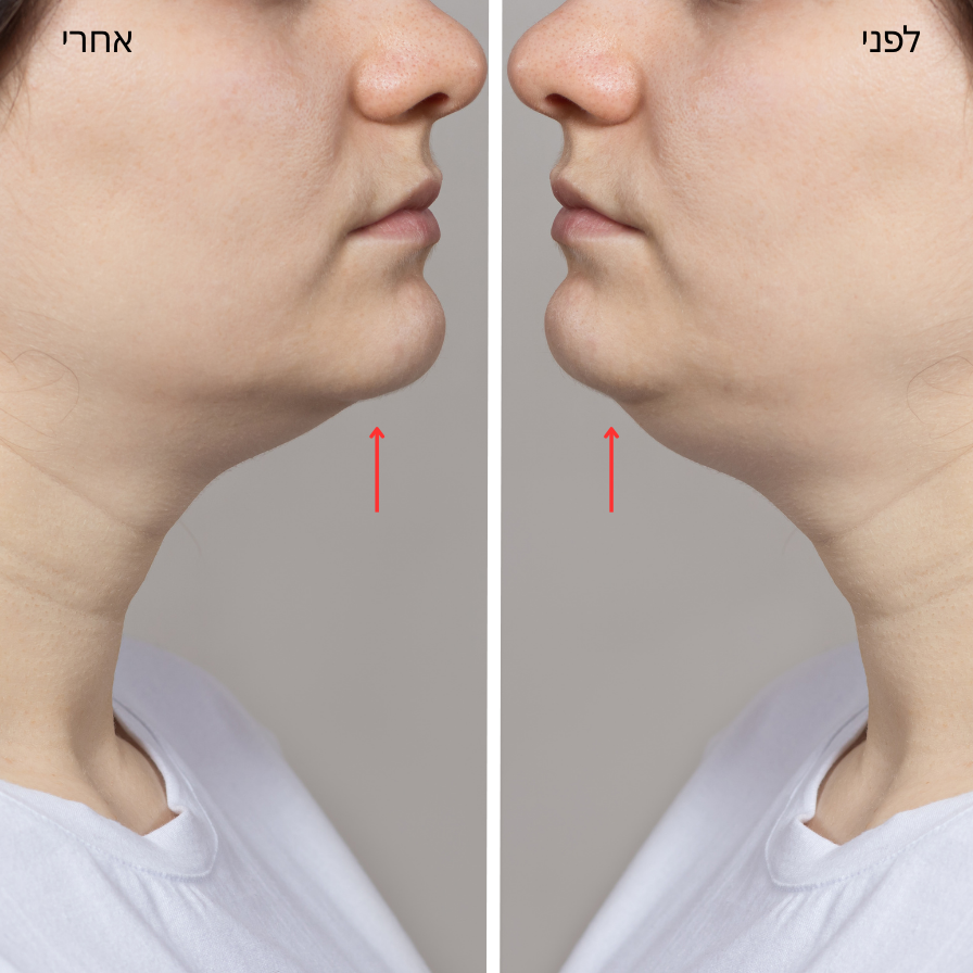 מדבקות סיליקון נגד קמטים בצוואר