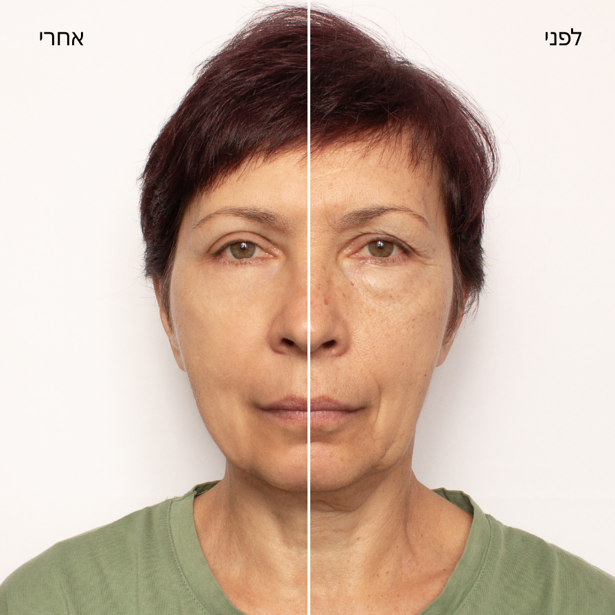 4 מדבקות סיליקון נגד קמטים לעיניים ולצידי הפה
